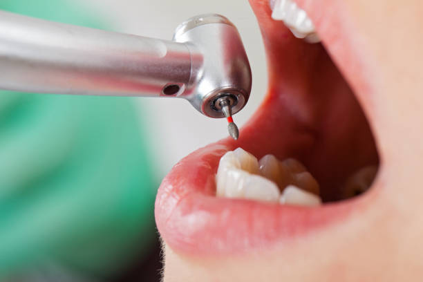 Best Emergency Dental Extractions in Orangevale, CA